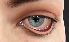 Ectropio1