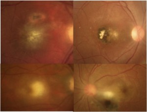 toxoplasmoza oculara