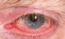 Half closed red and irritated eye with blood vessels