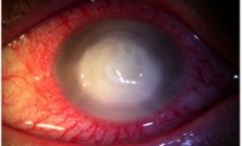 ulc-de-cornea2-300x210